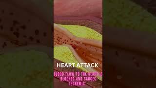 CARDIAC ARREST VS HEART ATTACK #shorts #cardio #nursing #medico #cardiacarrest #heartattack