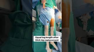 Live Xray-DAA Hip Replacement #minimallyinvasivesurgery #totalhipreplacement