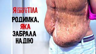 Невус, который разделил жизнь на ДО и ПОСЛЕ – Я соромлюсь свого тіла | МЕДИЦИНА | ВРАЧИ | ЗДОРОВЬЕ