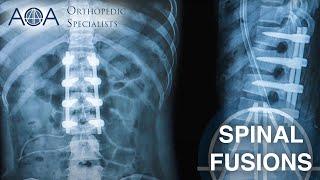 AOA Orthopedic Specialists - Spinal Fusions