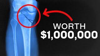 4 Surprising Injuries That May Pay You $1,000,000