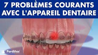 Urgence orthodontique - 7 PROBLÈMES courants avec l'APPAREIL dentaire ©