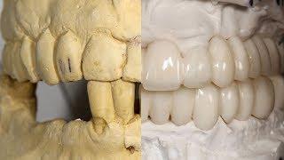 How To Make An Analog Temporary Prosthesis