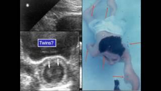 AIUM Webinar: Artifacts in Sonography