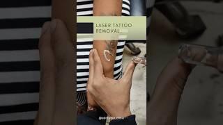 Painless Laser Tattoo Removal #tattooremover #laserclinic