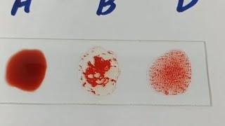 how to perform blood group||blood group|| ABO blood grouping||B positive blood group||