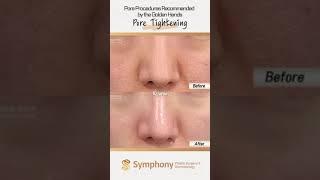 Best Pore Tightening Procedure in Korea? [Before and Afterp