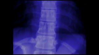 Areas of Inflammation in Ankylosing Spondylitis