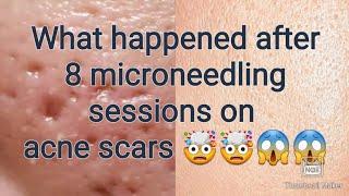 Microneedling Before & after pics 8 sessions on Acne scars !! Dermaroller !! Acne scar treatment !!