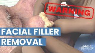 Removing YEARS OLD Facial Filler  Be careful where you get fillers from!  | CONTOUR DERMATOLOGY