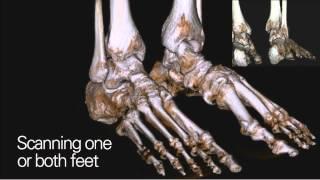 CurveBeam pedCAT: TRUE in-office weight bearing CT imaging