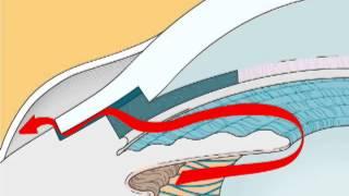 Normal Aqueous Drainage + Open-Angle Glaucoma + Glaucoma Filtering Surgery + Angle-Closure Glaucoma