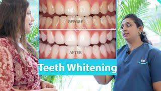 Teeth Whitening... Smile Kochi Dental Clinic +91 7999995339, +91 8877077079