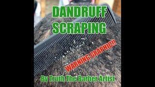 DANDRUFF SCRAPING BY TRUTH THE BARBER ARTIST ***WARNING GRAPHIC***