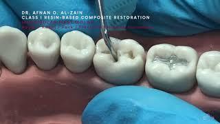 Class I composite restoration (2) – Slanting/oblique incremental technique (#36) - Arabic عربي