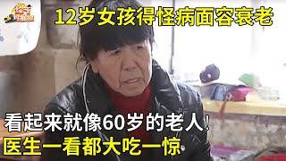 12岁女孩得怪病,面容衰老,看起来就像60岁的老人!医生一看都大吃一惊【真人真事】