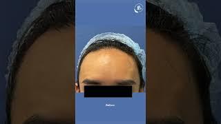 Hairline Advancement for receding hairline |#ffssurgery #facialfeminization  #Shorts #youtubeshorts