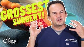 GROSSEST SURGERY EVER SEEN?! | Dr. Nick Campitelli