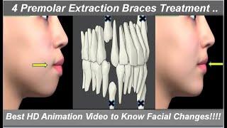 Changes in Face After 4 1st Premolars' Extraction & Braces Treatment. Best HD Animation @ Dr Ram MDS