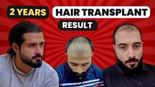 My 2 Years Turkey Hair Transplant Result & Review | Best Shampoo For Hair Loss