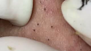 Relax Skincare Everyday with Acne Blackheads Treatment Spa #9788