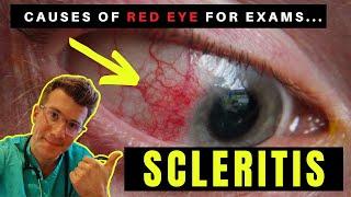 Causes of Red Eye - Part 3: SCLERITIS