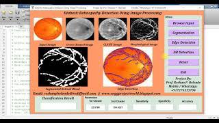 Diabetic Retinopathy Detection Using Image Processing | Matlab Project Source Code