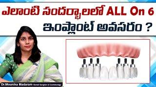 When All on 6 Dental Implants are Required.? || All on 6 Vs All on 4 || Eledent Dental Hospitals