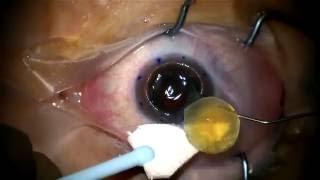 Dr. Vital: Removal of Cornea and Cataract