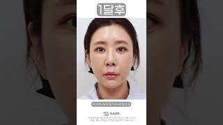 하안검+중안면거상+뒤밑트임 #성형외과 #눈성형 #코성형 #눈코성형 #눈재수술 #코재수술 #이마거상 #안면거상 #성형전후 #슈가성형외과 #자가늑코성형 #강남역성형외과