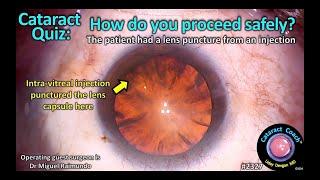 CataractCoach™ 2327: Cataract Quiz: How do you proceed safely? Intra-vitreal injection lens puncture