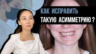 Перекрестный прикус. Причины. Последствия. Лечение.