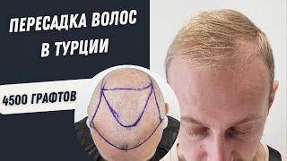 Пересадка волос в Турции | Пересадка Волос процесс 4500 графтов #пересадкаволос