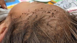 How to remove head lice from short hair - Taking out all hundred lice from hair