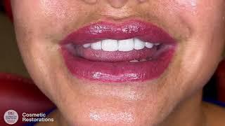 Cosmetic Restorations