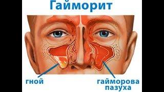 Избавление от насморка и гайморита за 5 минут