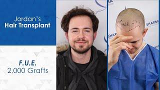 Jordan's Hair Transplant - Sharma Skin and Hair Surgery