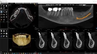 CS 8200 3D Model Scan and Implant Plan