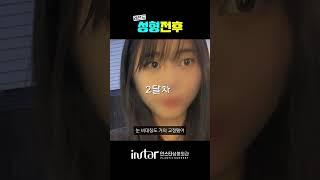 무쌍눈매교정, 멍, 붓기 회복기간, 결과까지 ‼️ #강남성형외과 #성형외과#무쌍 #무쌍눈매교정 #무쌍성형 #여자무쌍 #무쌍수술 #여자무쌍성형 #눈매교정 #눈매교정후기