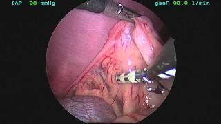 Laparoscopic Spay Dog  (Single Port) Dr. Jeffrey J Runge DVM, DACVS