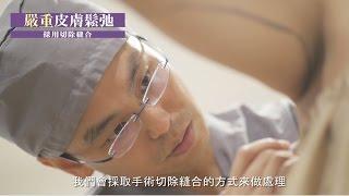 手臂抽脂手術 | 手臂抽脂改善蝴蝶袖粗手臂困擾 | Dr.吳孟穎醫師