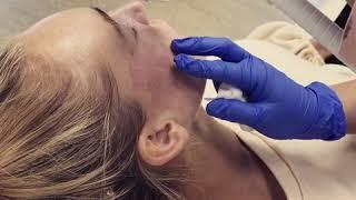 TIXEL Skin Resurfacing Treatment | Lumiere Clinic