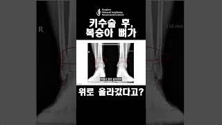 키수술에서 발목나사가 얼마나 중요한지 알게 해주는 영상