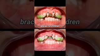 Braces for child #braces #dentist #orthodontist #dental