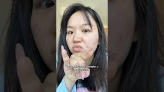 Just don’t touch ur face ig  #acne #relatable #nails