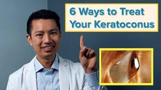 The 6 Best Ways to Treat Your Keratoconus: Orange County Eye Doctor Explains