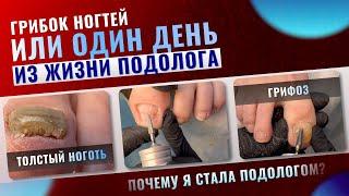 Грифоз / Толстый ноготь / Грибок ногтей или один день из жизни подолога