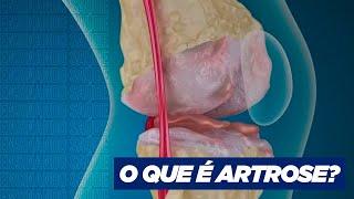 O QUE É ARTROSE?