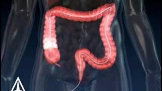 Colonoscopy - 3D Medical Animation