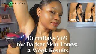  @AnastasiaItua Reviews DermRays V6S - Effective Laser Hair Removal for Darker Skin Tone